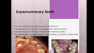 36-What is hyperdontia(supernumerary)?