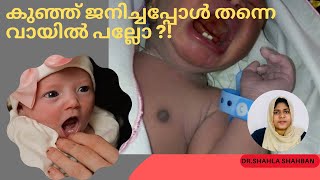 കുഞ്ഞ് ജനിച്ചപ്പോൾ തന്നെ വായിൽ പല്ലോ ?! |  Natal Teeth  | Neonatal teeth