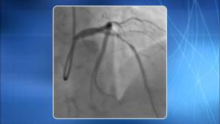Chapter 8: TRA for addressing Bifurcation Lesions