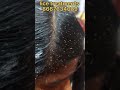 #lice #licetreatment #nits&licetreatments #pennu #eerru #lice treatments in tamil contact 8667634689