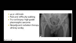 Proximal Femoral Resection by Dr. Ahmet Salduz