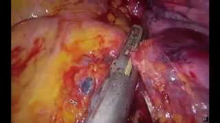 Uniportal VATS Lobectomy and Chest Wall Resection after chemotherapy