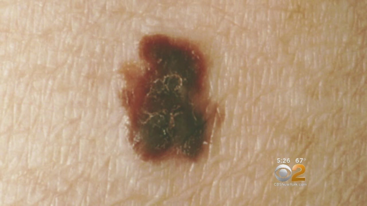 Melanoma Monday Puts Deadliest Form Of Skin Cancer In The Spotlight