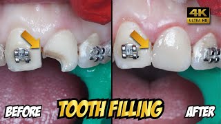 Front Tooth Filling to Repair Chipped Tooth | Dentist | Dokter Gigi Tri Putra