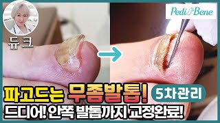 내성발톱 무좀발톱 5번째 관리 - 심각하게 안쪽까지 파고드는발톱 관리! 뿌리까지 깊숙한 발톱무좀 세심한 관리! ingrowntoenail