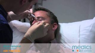 Facial Mole Removal - London Clinics