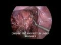 Laparoscopic Anterior Resection by Dr. Ajay Mandal