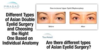 Determining Most Appropriate Type of Asian Double Eyelid Surgery Based on Individual Anatomy