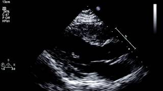 Does Bidirectional Ventricular Tachycardia Portend a More Fulminant Course in Acute Myocarditis? 1