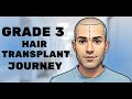 Hair Transplant in bhopal | Best Results & Cost of Hair Transplant in bhopal