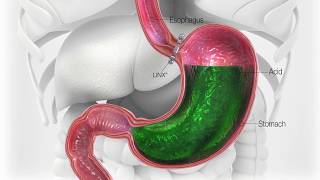 New Surgical Procedure to Help Cure Acid Reflux