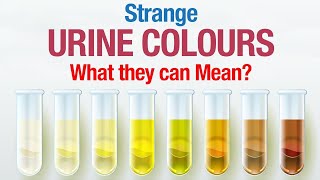 Urine Colour and its Effect on your Health