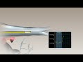 swan ganz catheter placement animation