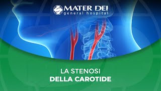 La stenosi della carotide