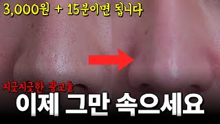 답답해서 올리는 블랙헤드 삭제 방법. 계속 생기면 이렇게 해보세요