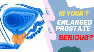 Is Your Enlarged Prostate SERIOUS? 😞 😞 😞Take This Test To Find Out