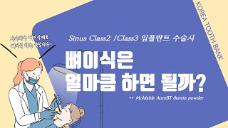 [한국치아은행] 62. Sinus class2, class3 임플란트 수술시, M.AutoBT dentin powder로 사용한다면 얼마큼 사용해야할까?