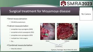 Educational Session 2 - Moyamoya disease: diagnosis and treatment (Sadamoto Lecture)  Hidenori Endo