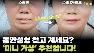 동안성형 찾고 계신다면, '미니 거상' 추천합니다! [1mm성형외과]｜ [일미리성형외과]