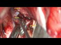 ACOM -A ANTERIOR COMMUNICATING ARTERY ANEURYSM-microsurgery-dr suresh dugani/HUBBALLI/INDIA