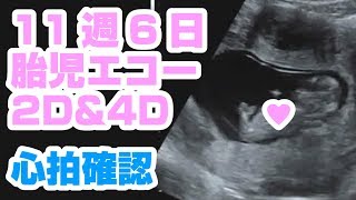 胎児エコー動画2D\u00264D 11週6日め baby echo 2D 4D 11w6d【心拍確認！】