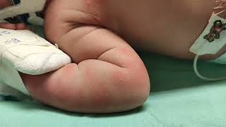 Medical Education Videos: Neonatology: Erythema Toxicum in Newborn