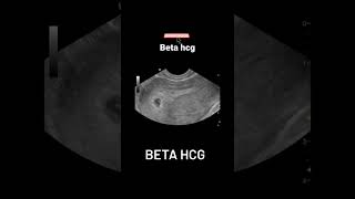 beta HCG e primeira ultrassonografia