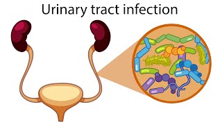 Urinary tract infection web embeddable