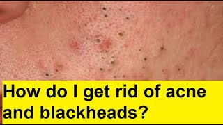 How do I get rid of acne and blackheads?