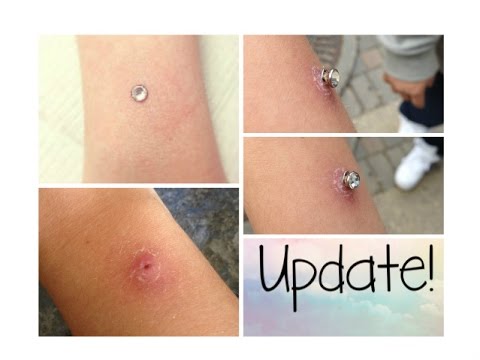 Wrist Dermal Healing Update! Wrist Dermal Healing Update!