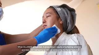 Ellanse full face treatment