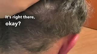 Bad FUE Scarring vs Good FUT Scarring in this Hair Transplant Corrective Patient in Dallas, Texas