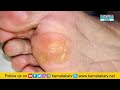 what is the reason for the nail in the leg.. how to remove it.. how to remove ingrown nail.. ktv health