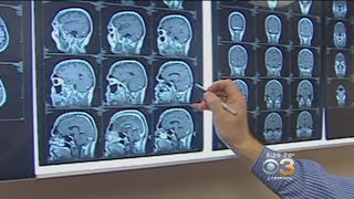 CDC Releases New Guidelines To Improve Concussion Treatment