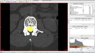 Materialise Mimics and 3Matic Tutorial