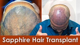 Sapphire Hair Transplant Surgery Review in Nashik | Grade 6 Baldness | New Roots Clinic