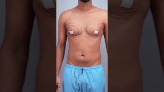 Manboobs cure | Gynecomastia surgery immediate result #shorts