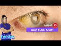 ما هي اسباب اصفرار العين؟