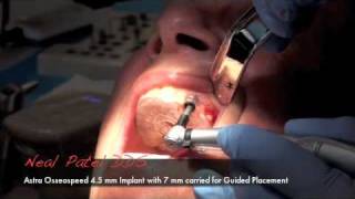 Implant Surgery