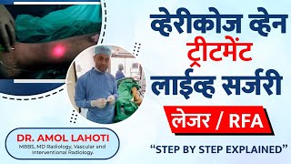 वैरिकोज़  वेन ट्रीटमेन्ट लाईव्ह सर्जरी | Dr. Amol Lahoti