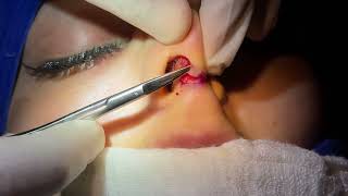 Open Rhinoplasty