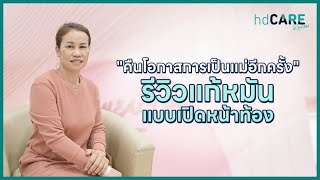 รีวิวแก้หมันหญิงในวัย 40+ แก้หมันแล้วมีลูกได้เลยไหม? โอกาสมีลูกแค่ไหน? แก้หมันด้วยบริการจาก HDcare