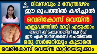 ദിവസവും 2 നേന്ത്രപഴം ഈ രൂപത്തിൽ കഴിച്ചാൽ വെരികോസ് വെയ്ൻ എളുപ്പത്തിൽ മാറ്റിയെടുക്കാം |vericose vein