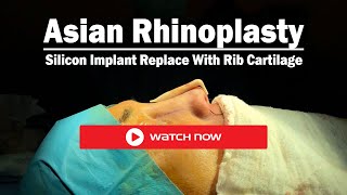 Dr. Bora Ok, MD. - Revision Asian (Ethnic) Rhinoplasty Surgery - Before & After Transformation