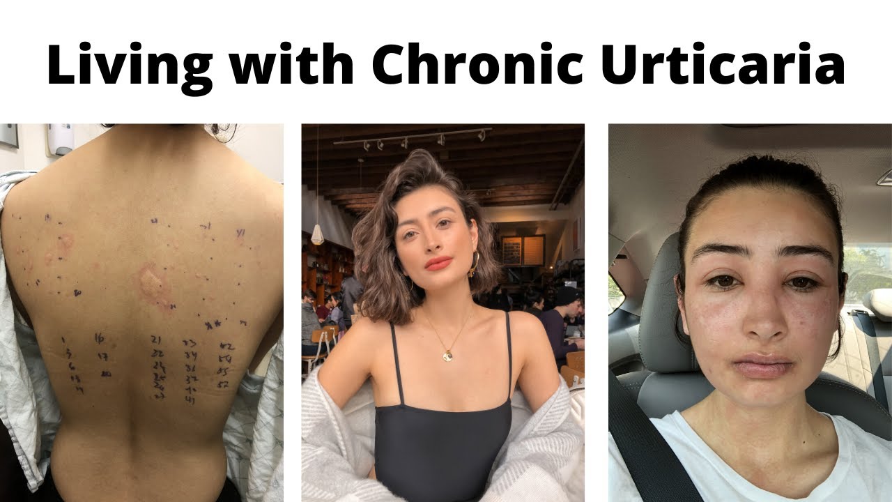 Living With Chronic Urticaria - My First Flareup + Q&A | Autoimmune ...