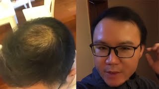 男子秃顶后坚持不用洗发水，半个月后照镜子乐翻了：长头发了！