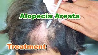 Alopecia Areata Treatment by ILS (Intralesional Steroid) Injections | Triamcinol