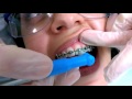 Tips on Using the Occlusal Brush for Orthodontics