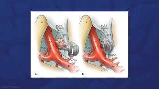 Microsurgical Clipping of a Ruptured Posterior Communicating Artery Aneurysm