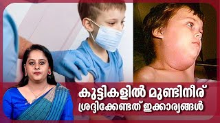 കുട്ടികളില്‍ മുണ്ടിനീര്, ശ്രദ്ദിക്കേണ്ടത് ഇക്കാര്യങ്ങള്‍ | Mumps | Health | Kerala